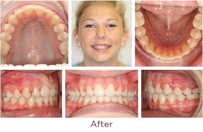 Class 2 orthodontic problem after