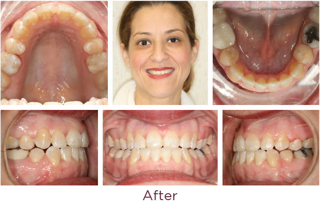 Class 3 orthodontic problem after
