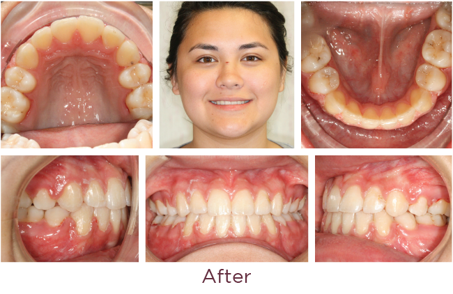 Extraction orthodontic problem after