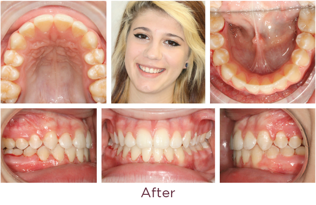 Posterior openbite orthodontic problem after