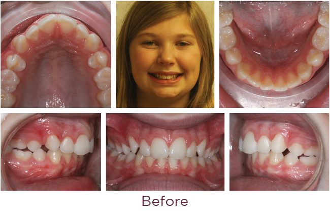 Class 2 orthodontic problem before