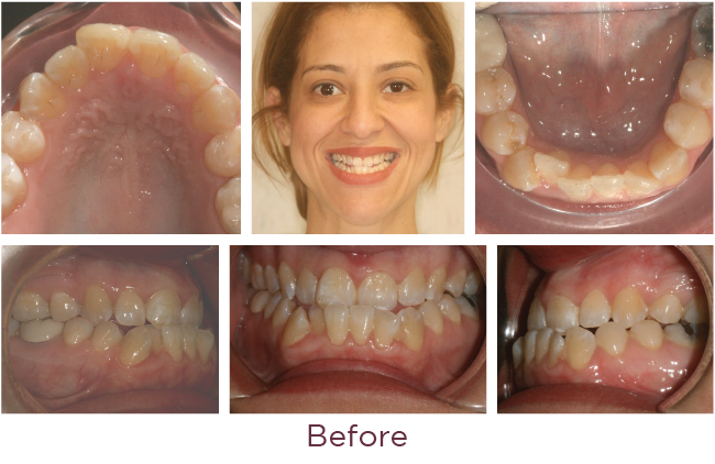 Class 3 orthodontic problem before