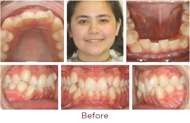 Extraction orthodontic problem before