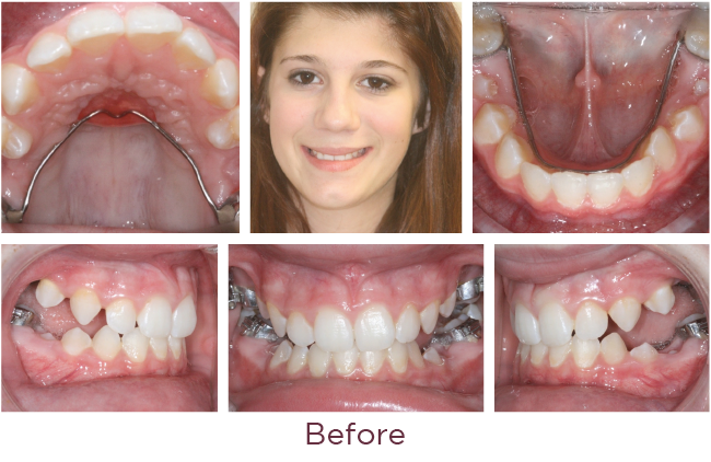 Posterior openbite orthodontic problem before