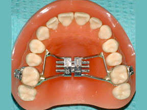 Orthodontic Appliances